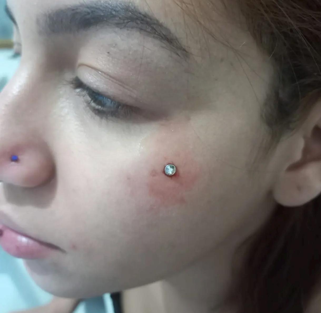 Microdermal